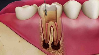 عصب کشی دندان, عصب کشی دندان